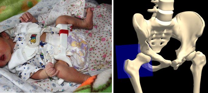 Bild links: Kleinkind mit Flexionsorthese. Bild rechts: Skelettmodell mit eingezeichneter Bildebene der Ultraschallbilder