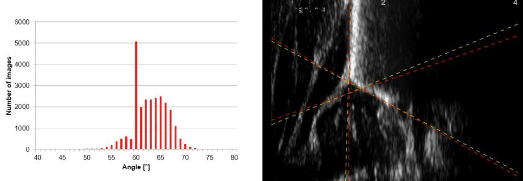 Picture left: Distribution of angles determined by doctors in the dataset of the study. Picture on the right: Ultrasound image with lines drawn in for angle determination (yellow: doctor, red: algorithm).