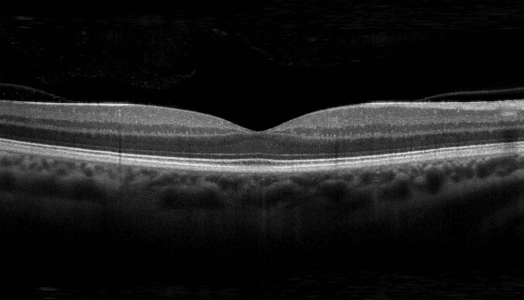 A black-and-white OCT scan using the "Medical Technology" software clearly shows the layers of the retinal structures.